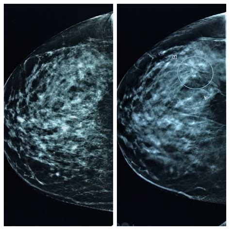 unable to do breast cancer test due to hard implants|breast implants vs mammogram.